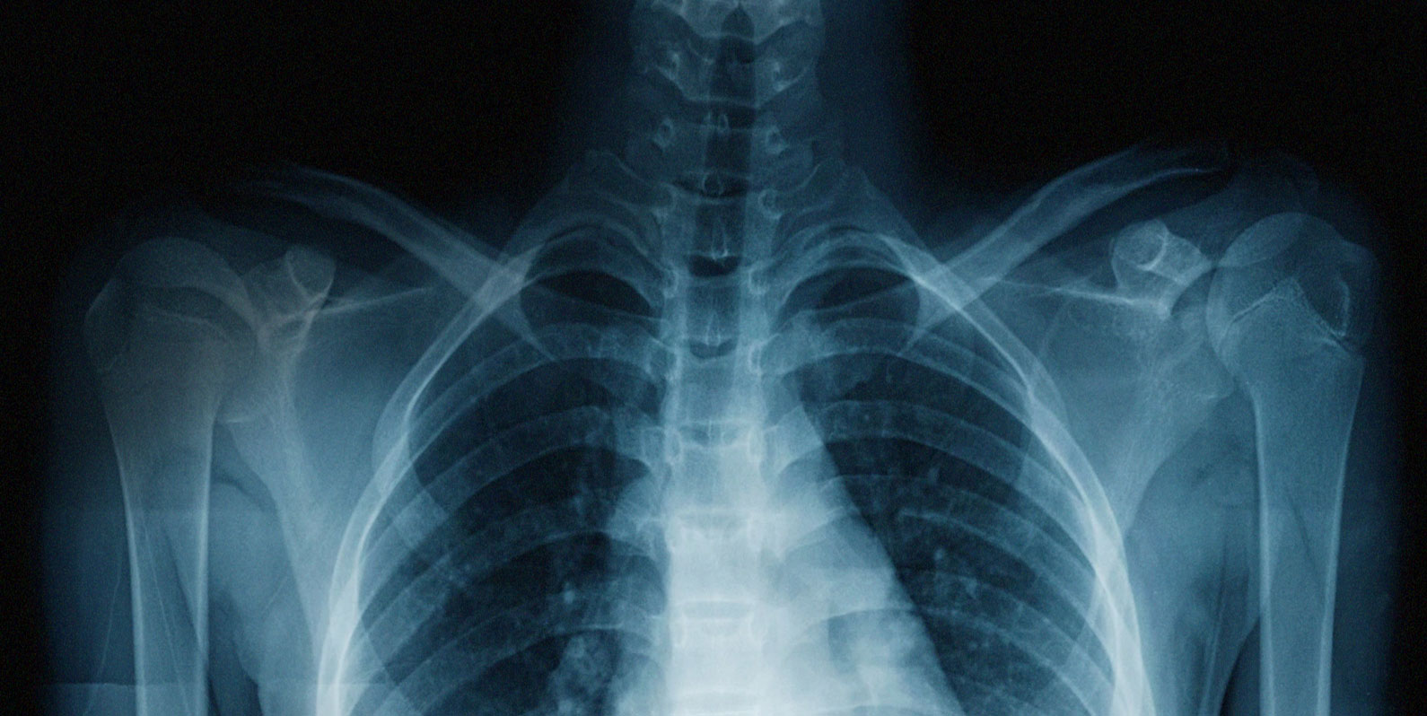 Uma Inteligência Artificial usou prontuários médicos para aprender a detectar doenças em radiografias de tórax