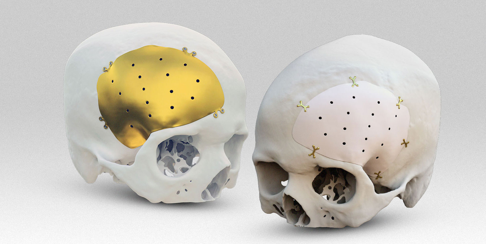 Próteses cranianas por impressão 3D: realidade acessível aos pacientes do SUS