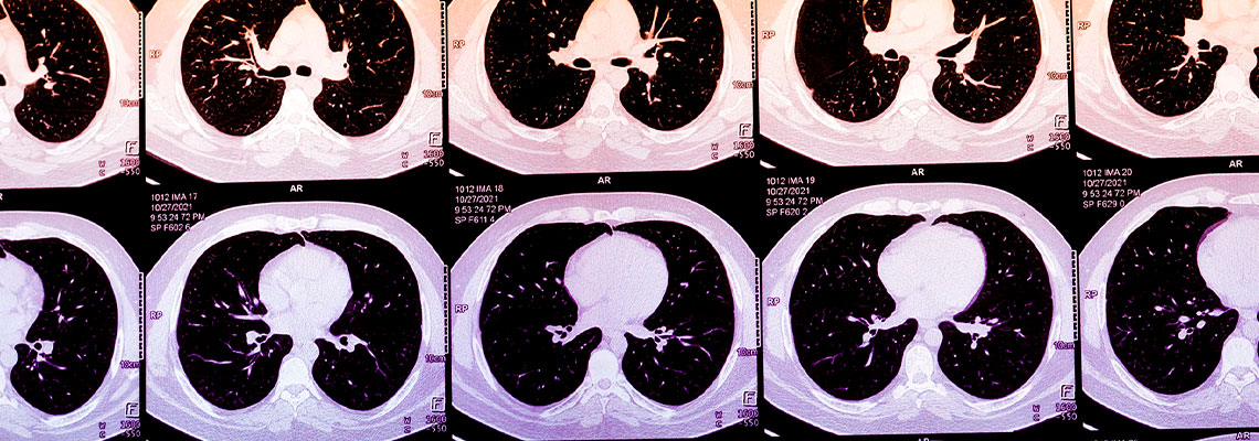 Inteligência Artificial pode prever um ataque cardíaco